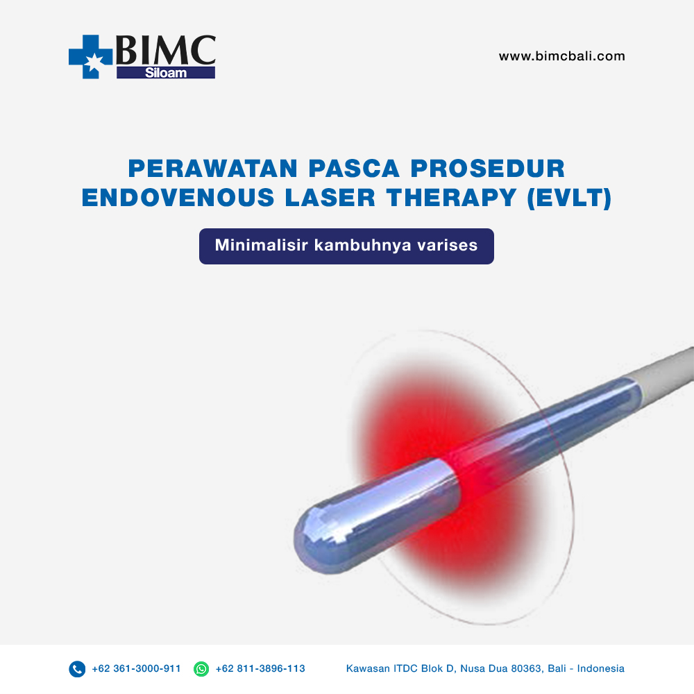 Perawatan pasca prosedur  Endovenous Laser Therapy (EVLT) minimalisir kambuhnya varises