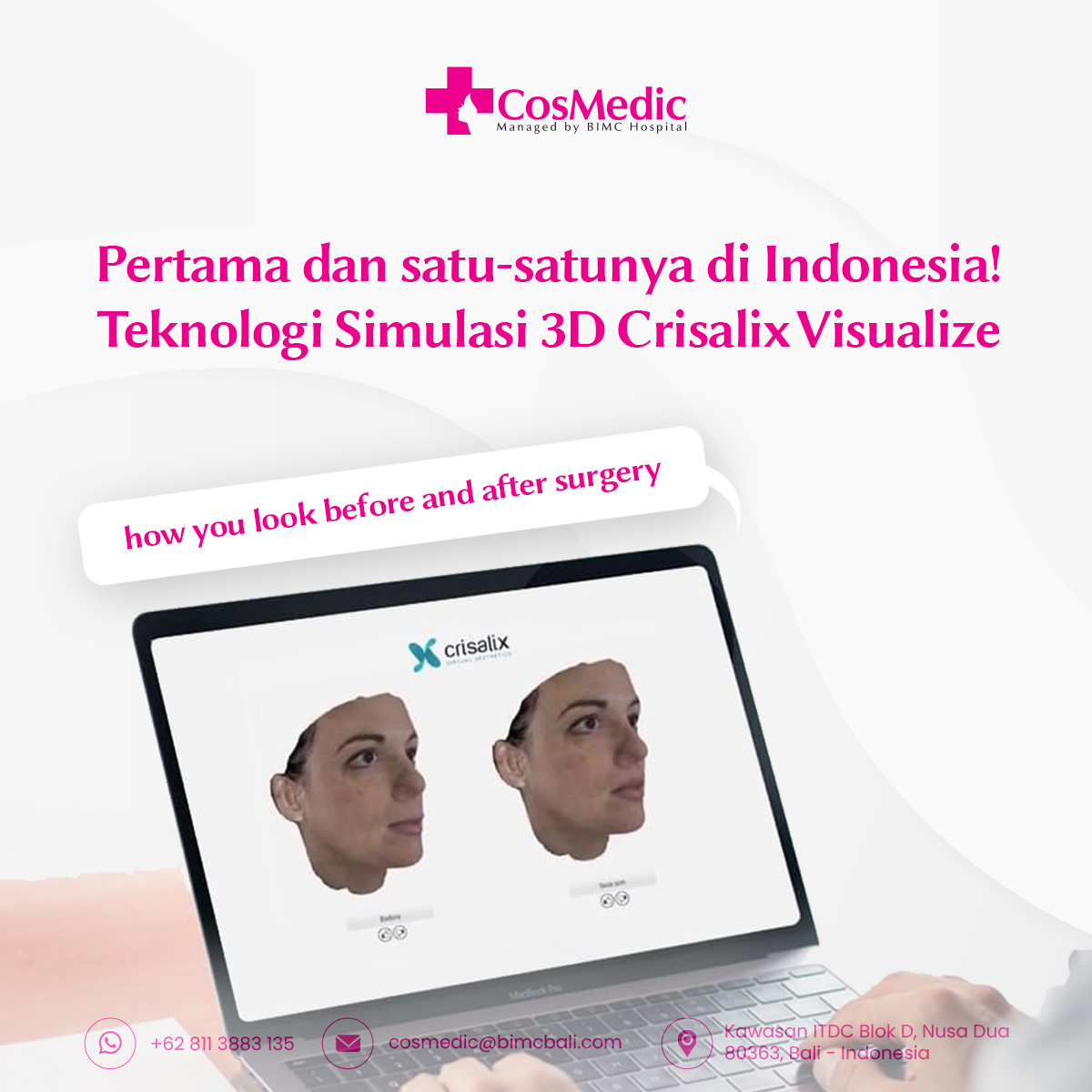 Pertama dan satu-satunya di Indonesia! Teknologi Simulasi 3D Crisalix  Visualize how you look before and after surgery
