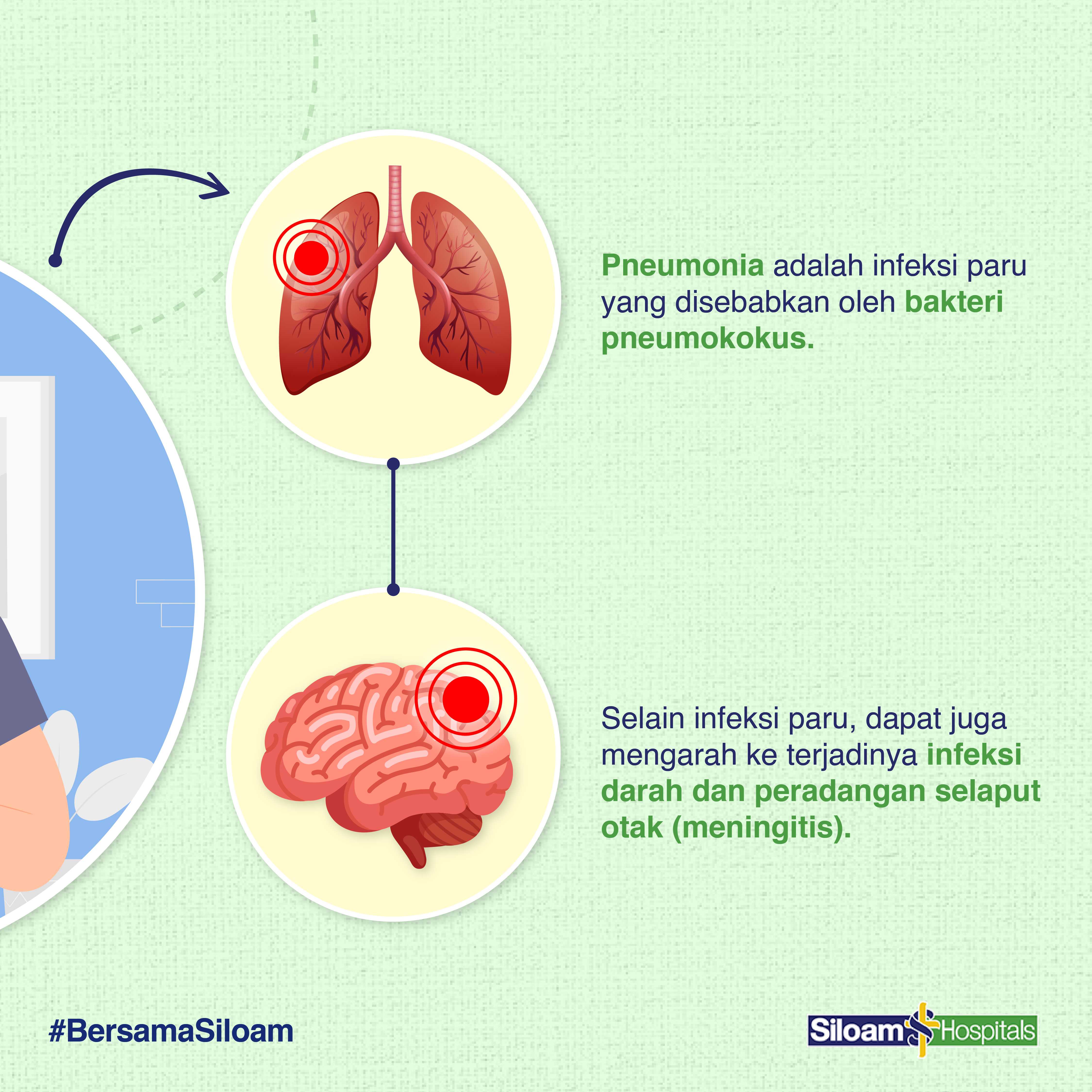 Waspada! Pneumonia Bisa Mengancam Nyawa